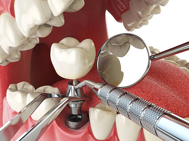 Best Emergency Dental Care for Abscessed Tooth in Rock Hill, MO